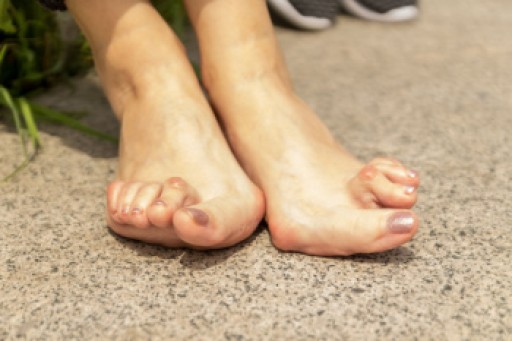 Rheumatoid Arthritis in the Feet