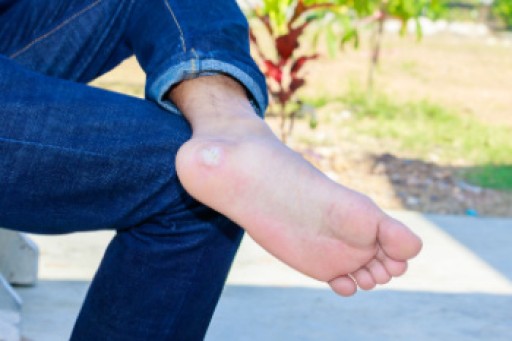 What Are Plantar Warts?