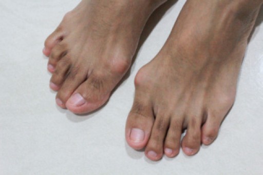 Bunions